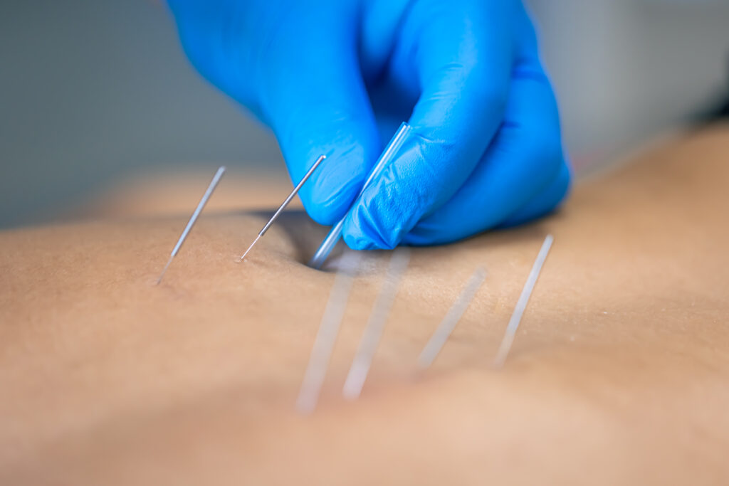 formation dry needling illustration