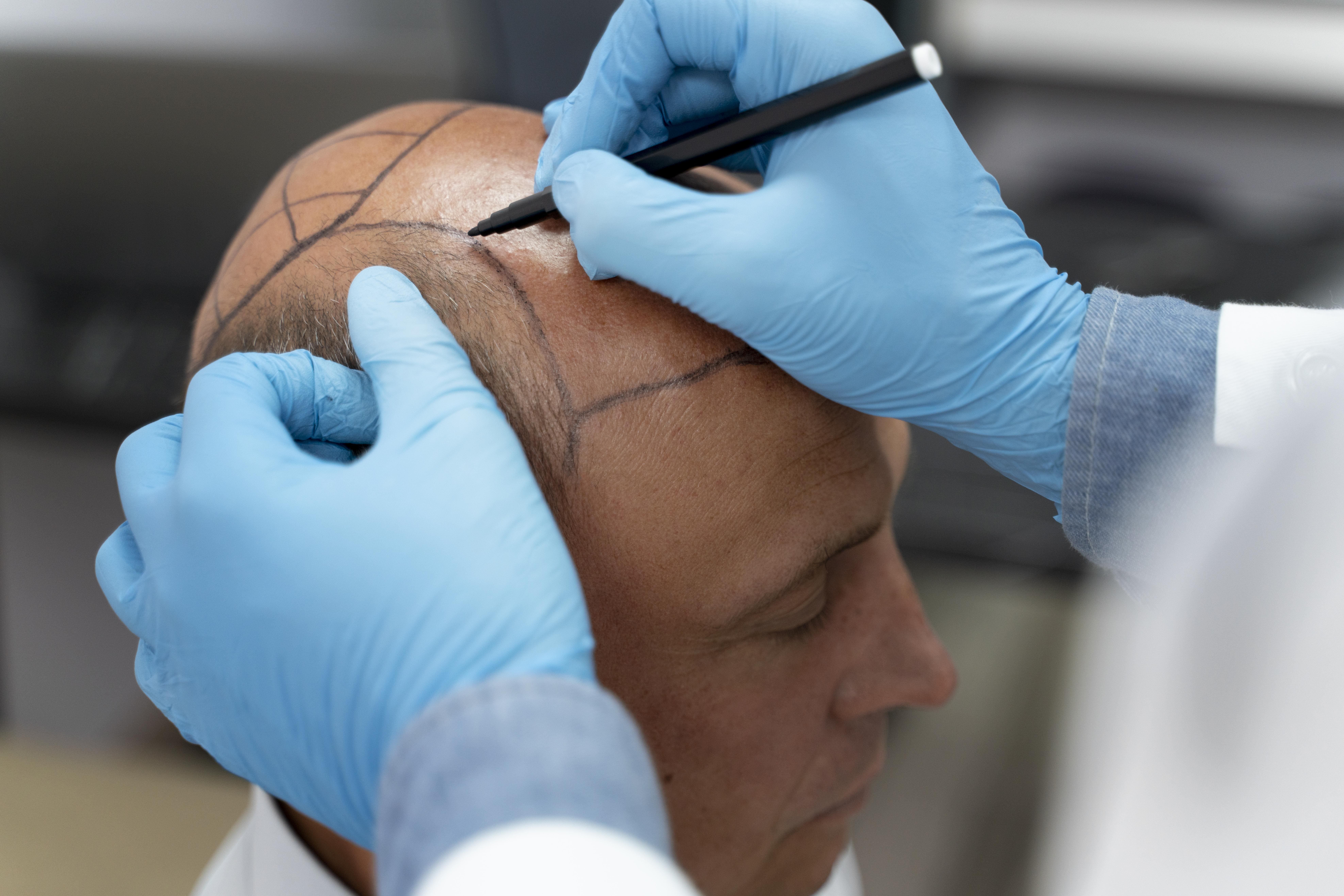 tricopigmentation institut beaute pour les hommes